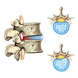 Schematic drawing of hernia of the disc slipped disc